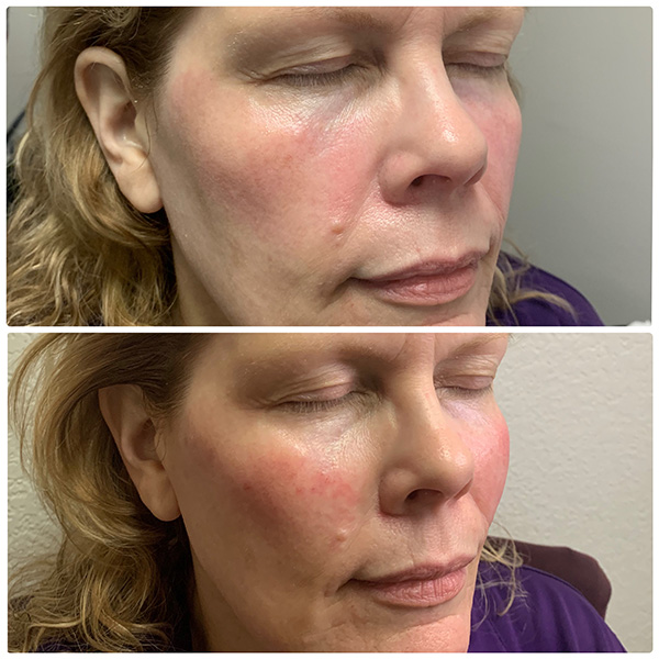 injectables--4018