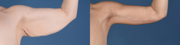 loose skin after weight loss